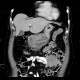 Gastritis, acute, antral: CT - Computed tomography